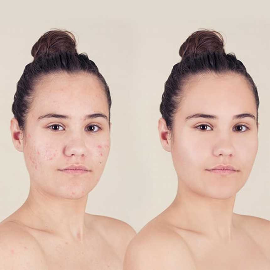  How one can Cowl Up Zits with Make-up